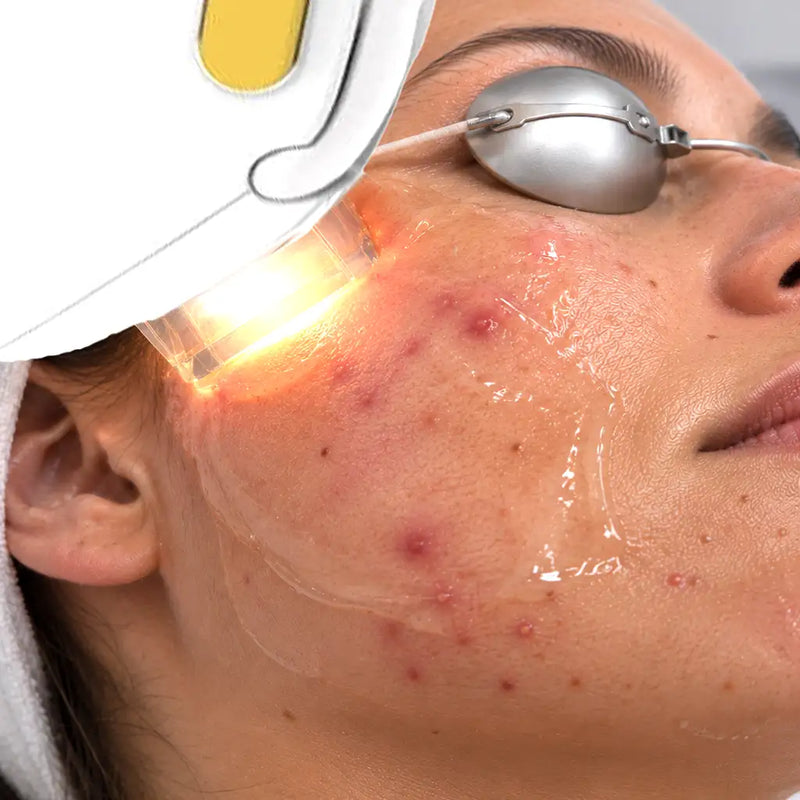 IPL bij acne: hoe werkt licht bij acne?